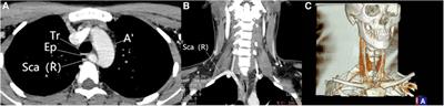 Non-recurrent right laryngeal nerve identified during endoscopic thyroidectomy via areolar approach: a case report